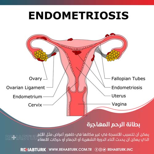 Endometriosis treatment in Türkiye