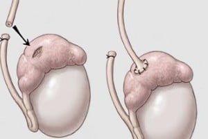 Vasectomy reversal surgery in Türkiye