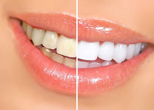 Teeth whitening in Türkiye