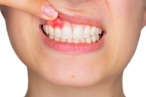 Gum disease treatment in Türkiye