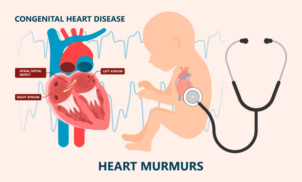 patent ductus arteriosus