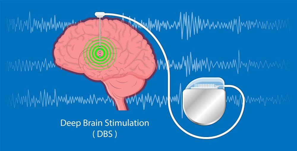 Deep brain stimulation in Türkiye