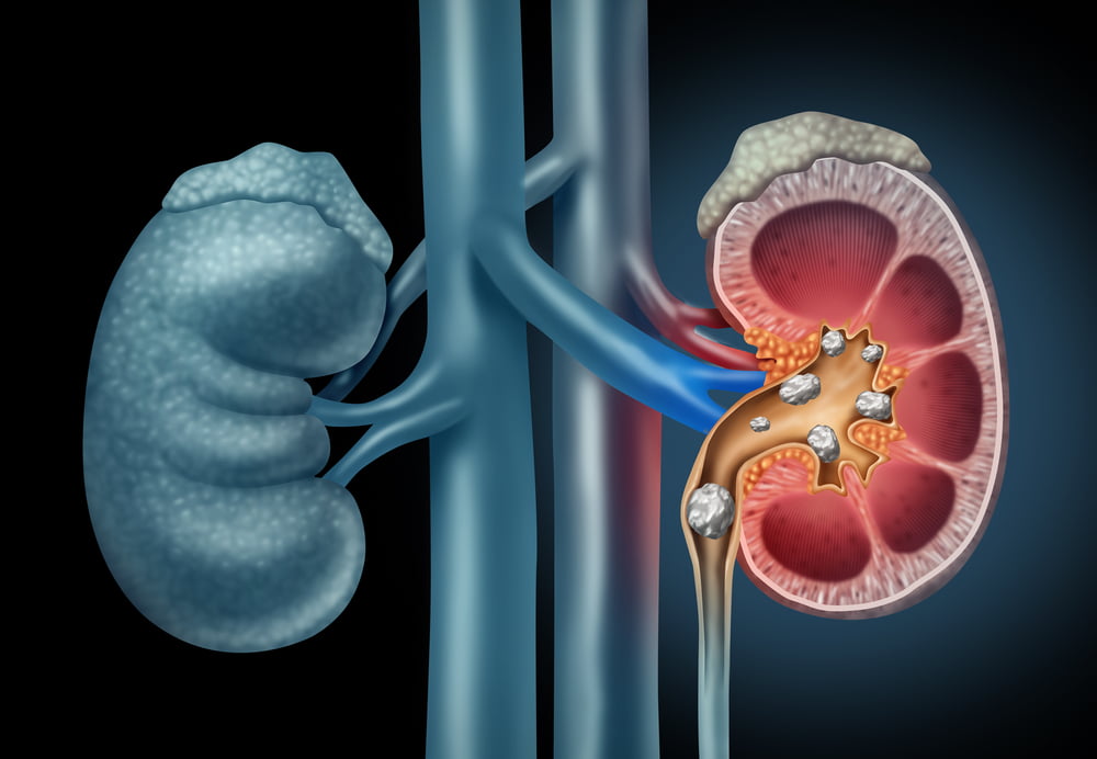 Kidney stones and methods of their removal in Türkiye