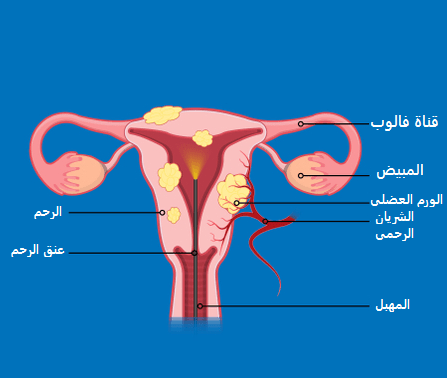 Myomectomy in Türkiye