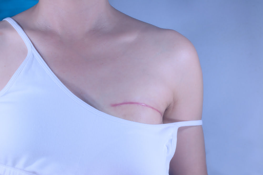 Partial mastectomy in Türkiye