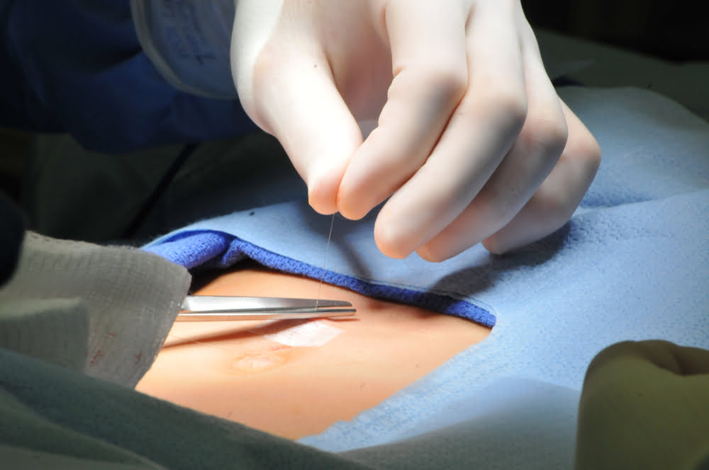 Umbilical hernia surgery in Türkiye