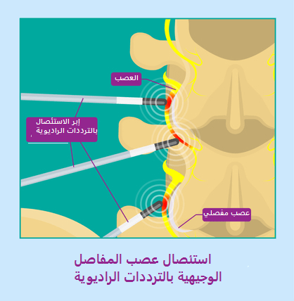 Radiofrequency ablation of facet nerves