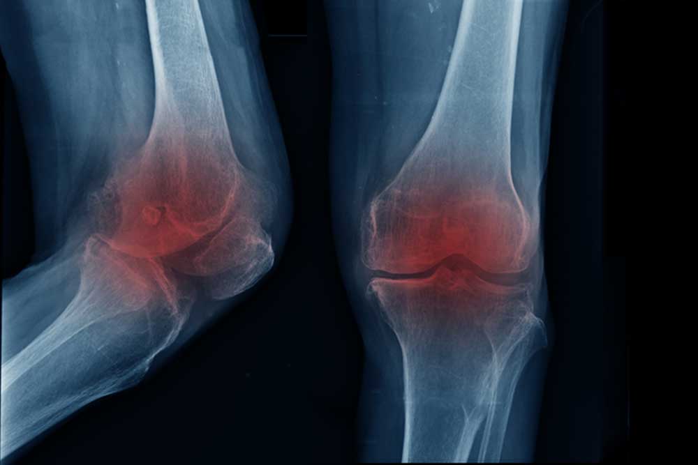 Knee flexion deformity treatment in Türkiye