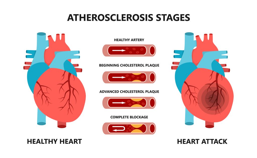 What is a heart valve replacement?