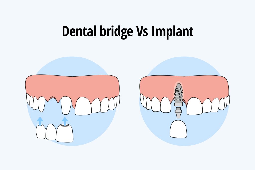Which option is preferable: dentures or bridges, or dental implants?