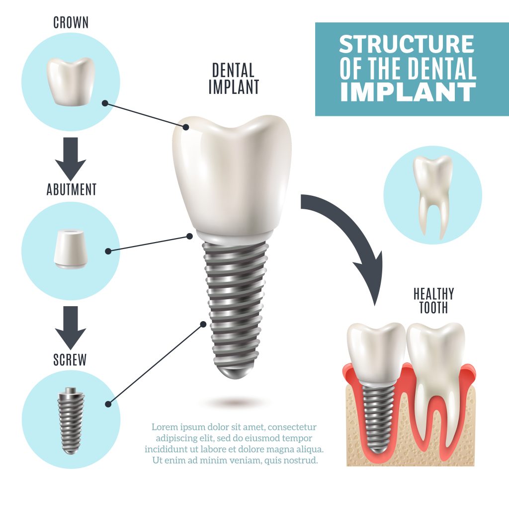 dental implants