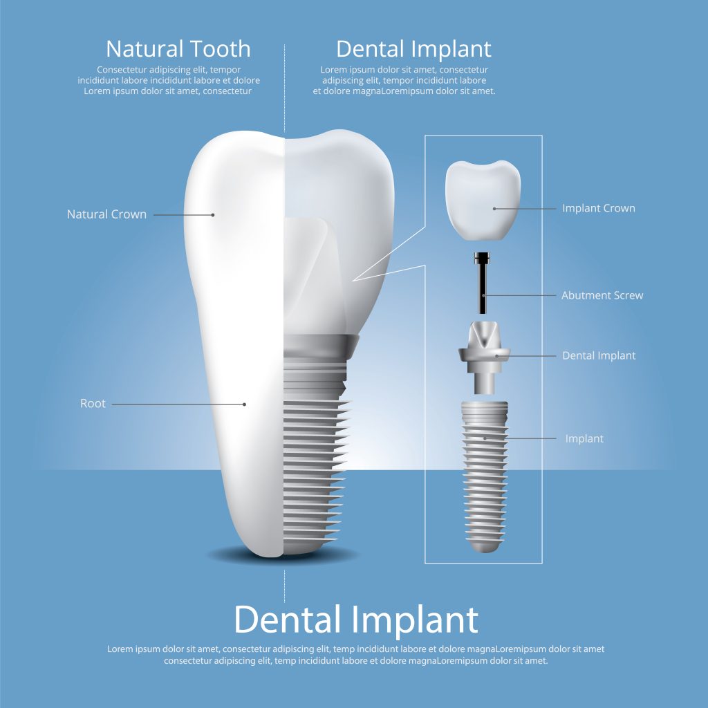 Are same-day dental implants suitable for you?