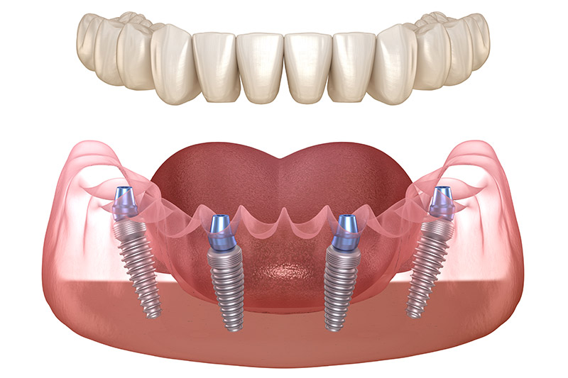 What Is All On Four Implant Treatment?