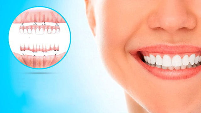 What Is All On Four Implant Treatment?