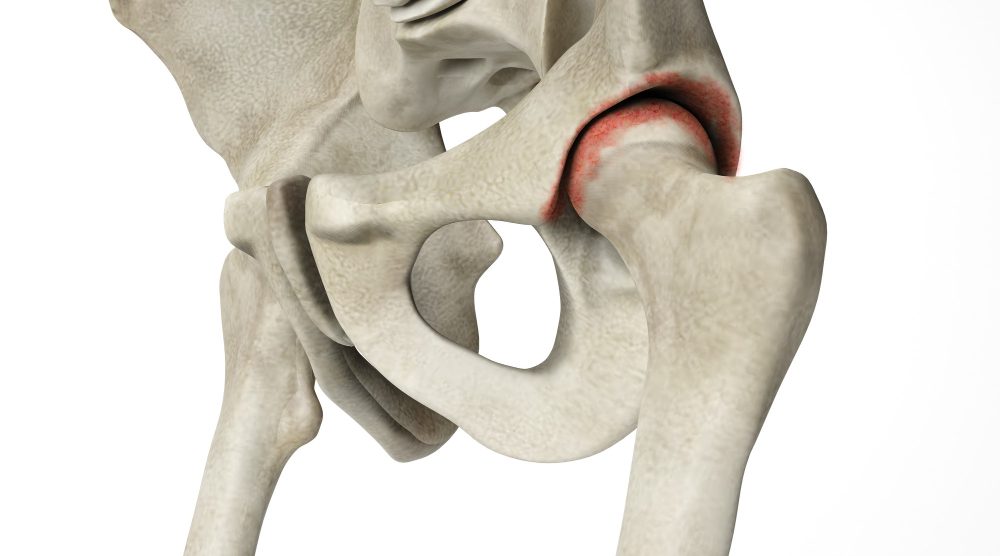 When a hip replacement is needed?