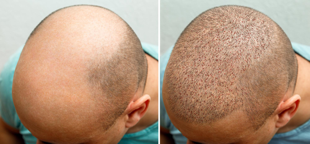 Who can have a hair transplant?