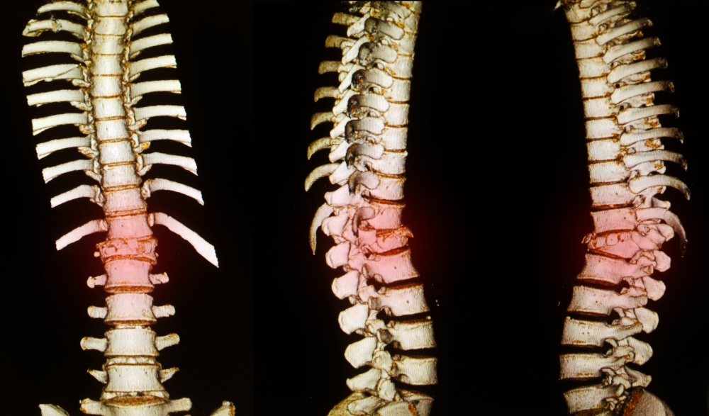 What is Complex Spinal Reconstruction?