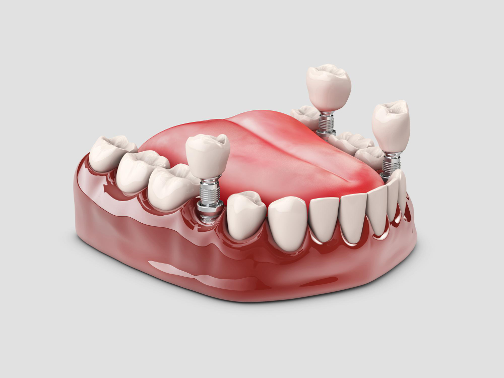 What are dental implants?