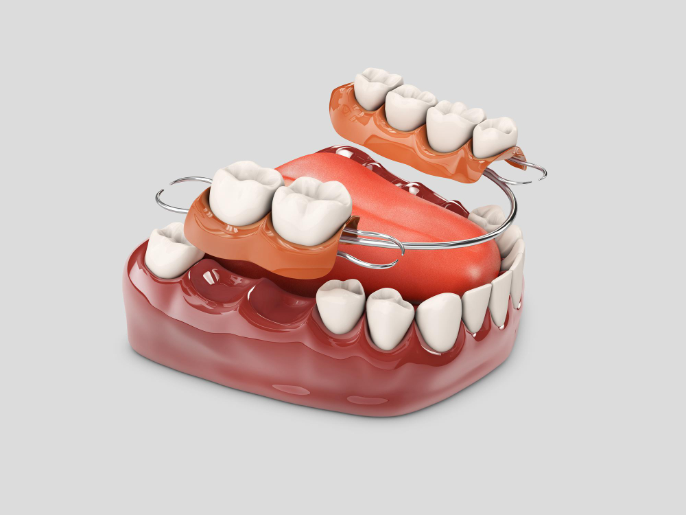 Which option is preferable: dentures or bridges, or dental implants?
