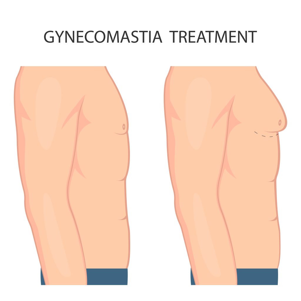 Male Breast Reduction Surgery (gynecomastia).