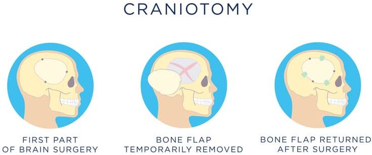 Craniotomy surgery