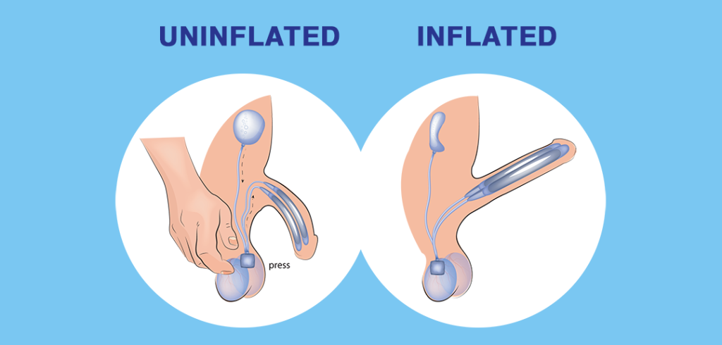 What is a penile implant?