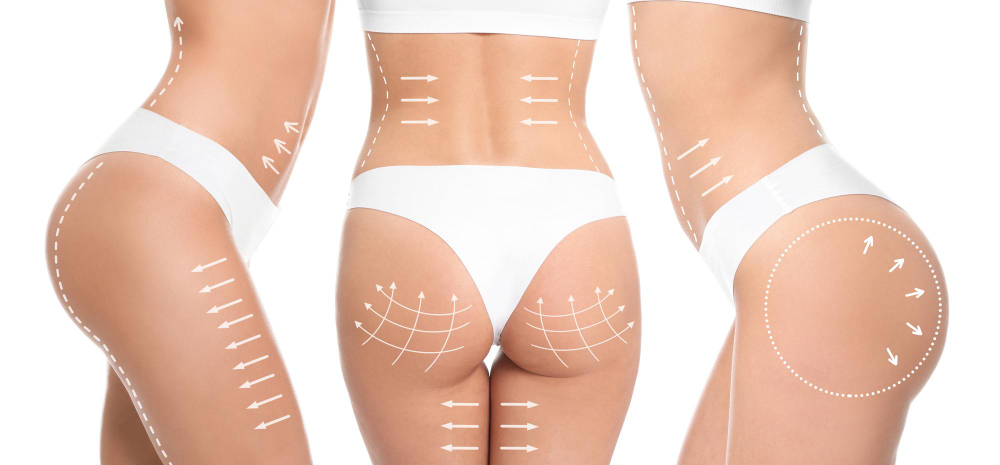 What is Buttock Lift Surgery?