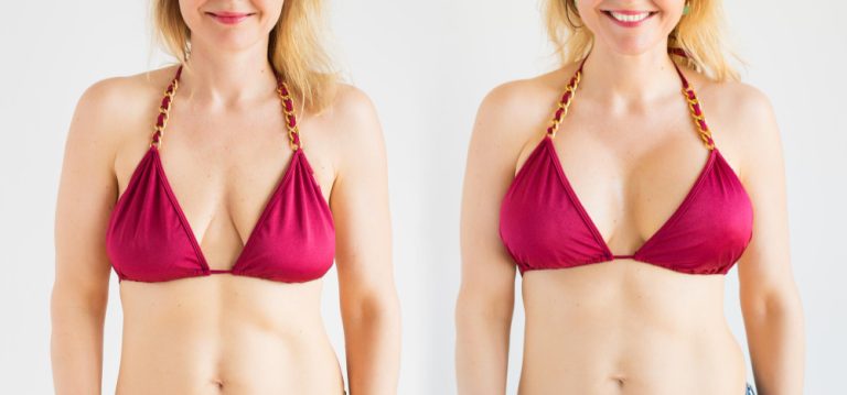What is Breast Augmentation Surgery?
