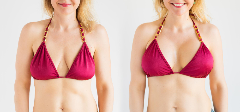 What is Breast Augmentation Surgery?