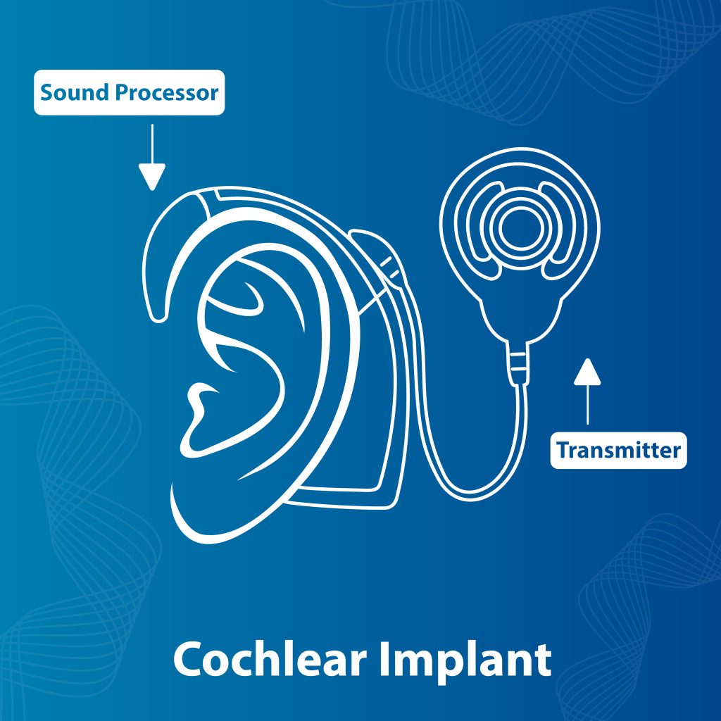 Cochlear Implant Surgery