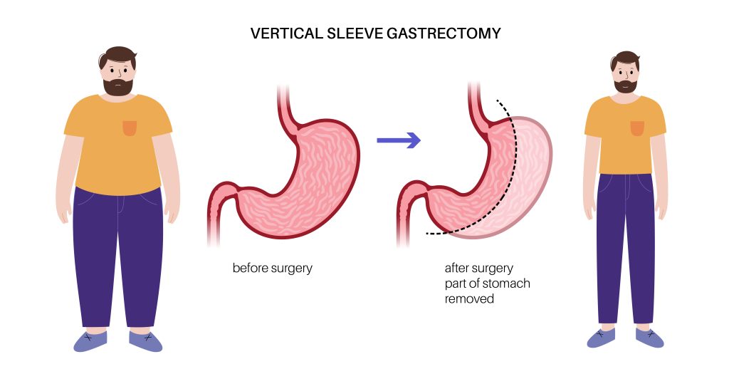 What is Sleeve Gastrectomy?