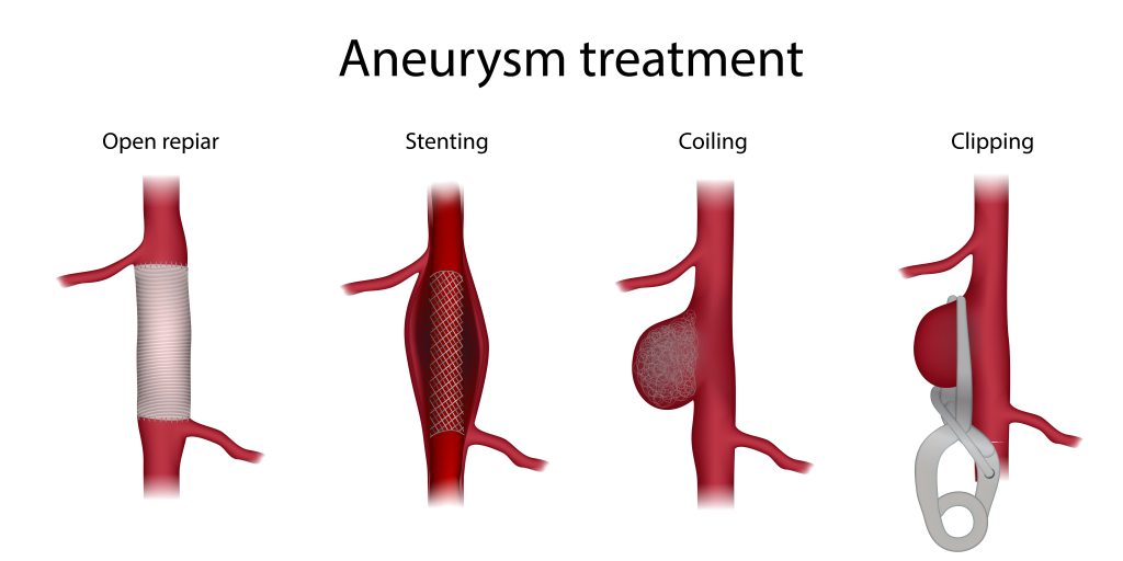 Brain Aneurysm Treatment