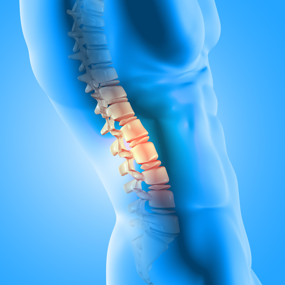 What Is Spinal Fusion?