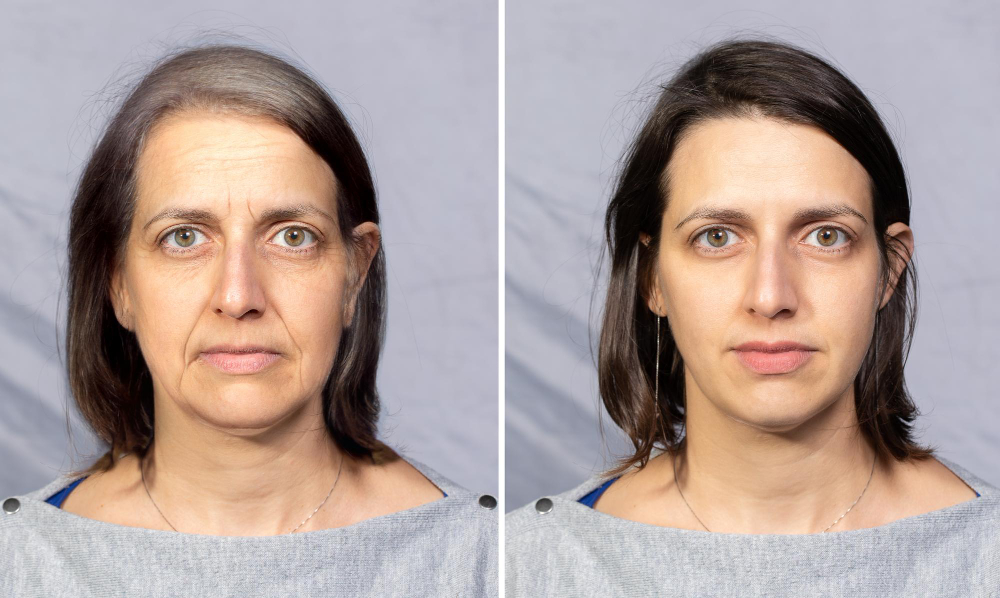What is a facelift?