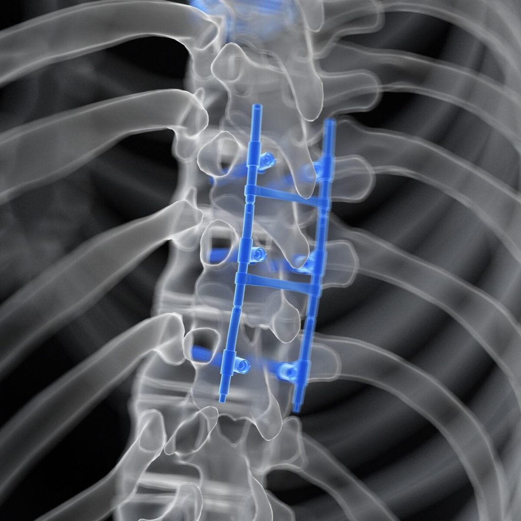 What Is Spinal Fusion?