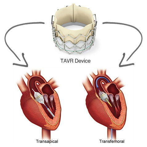 What is a TAVR procedure?