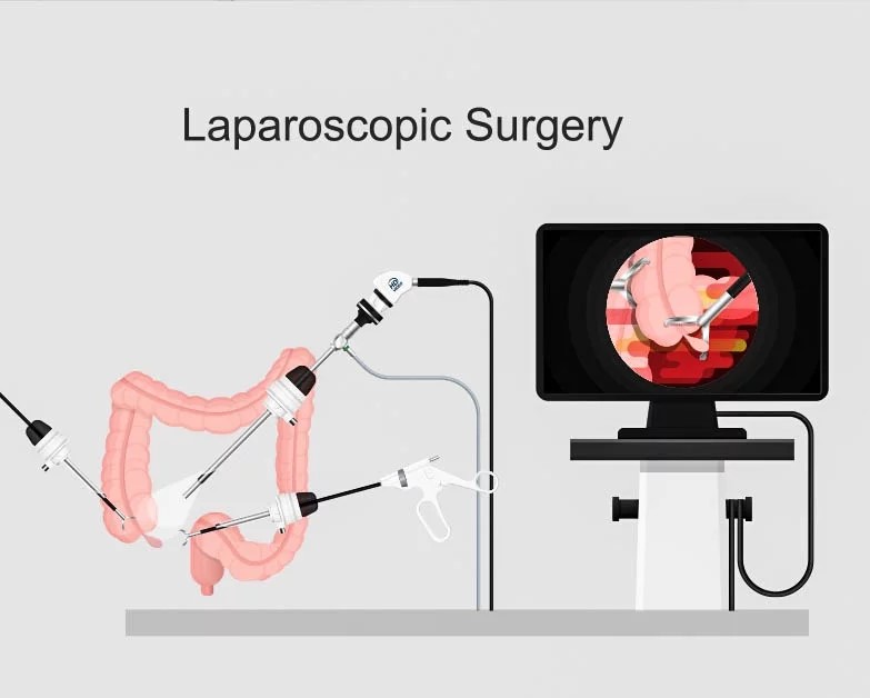 Laparoscopy