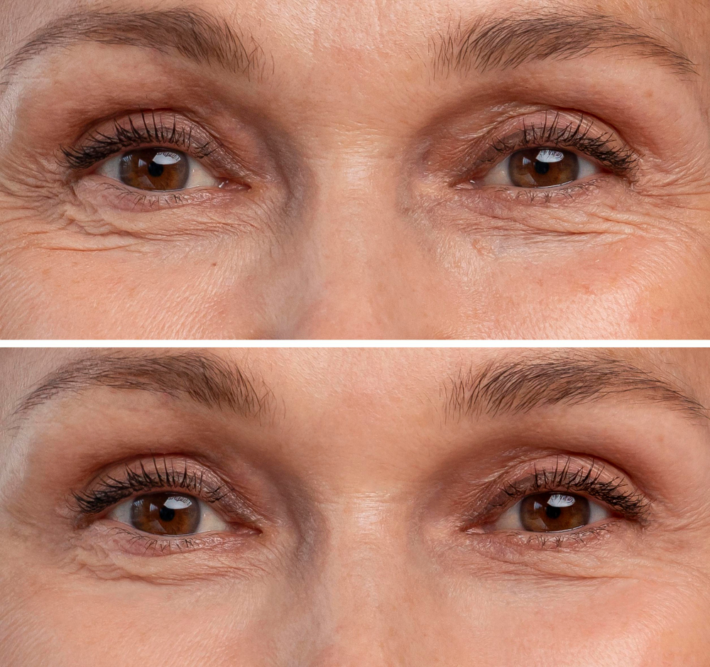 Eyelid surgery, or blepharoplasty Treatment Methods