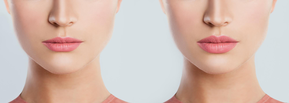 Lip Augmentation | Types of Lip lift & Injections and Fillers