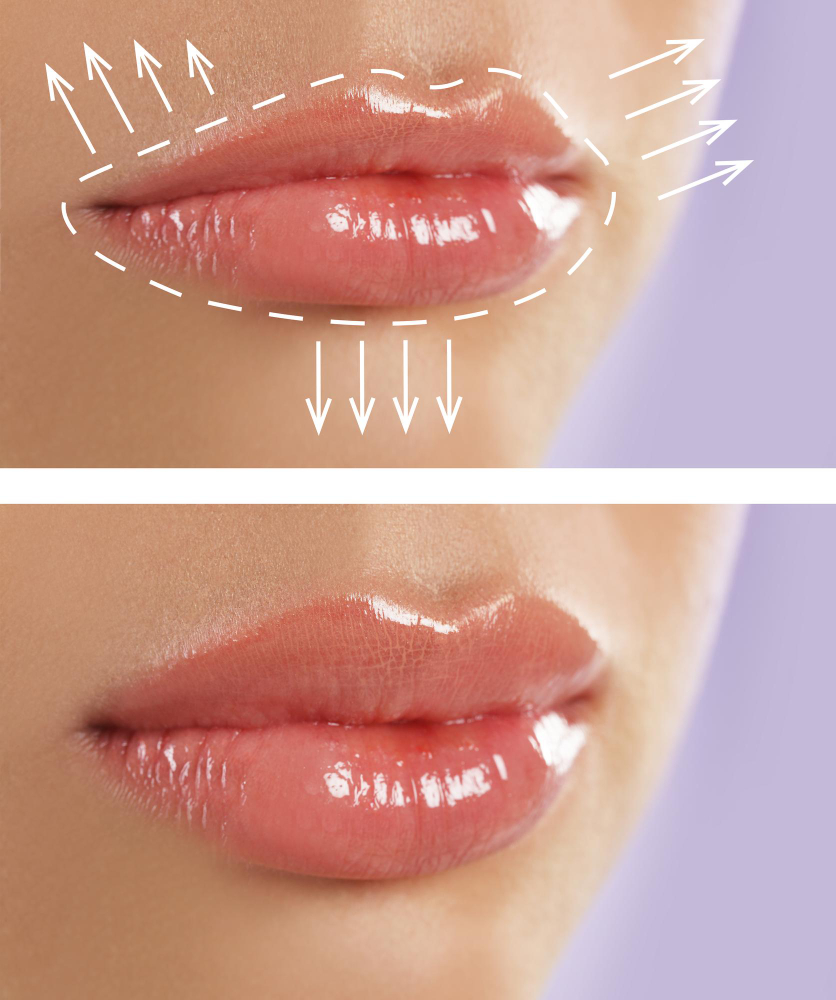 What is a lip flip?
