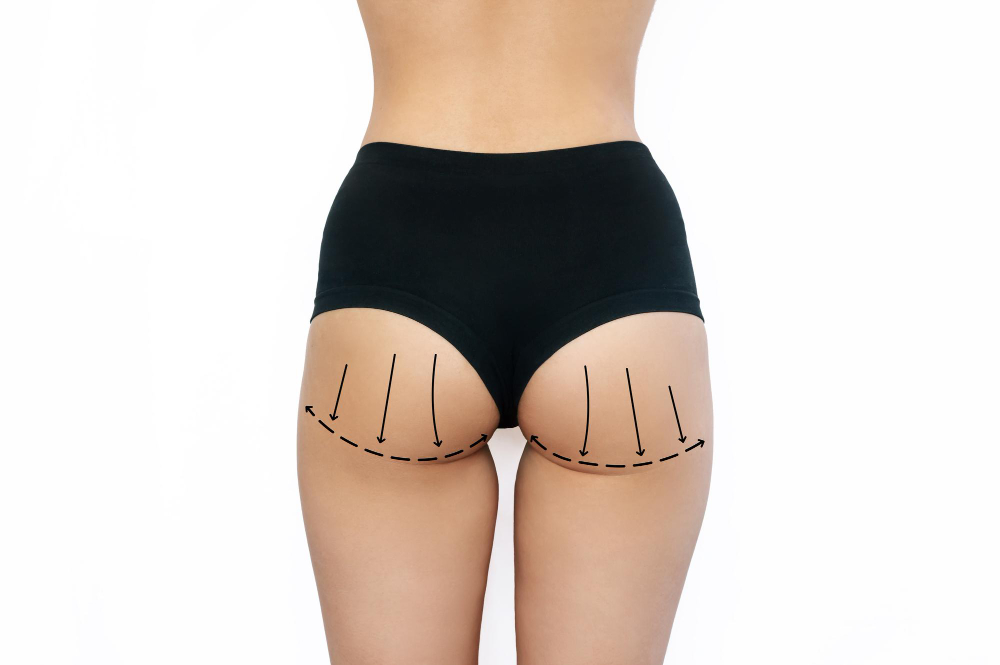 What is butt augmentation?