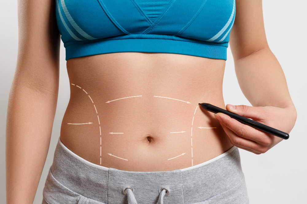 Panniculectomy vs. Tummy Tuck