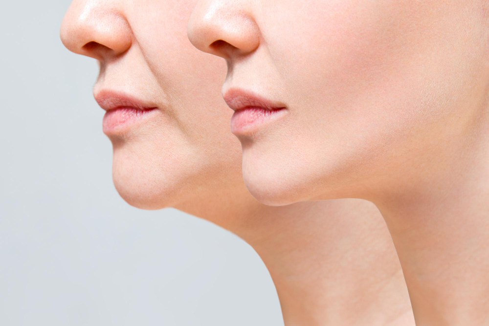 Chin Implant (CHIN AUGMENTATION)