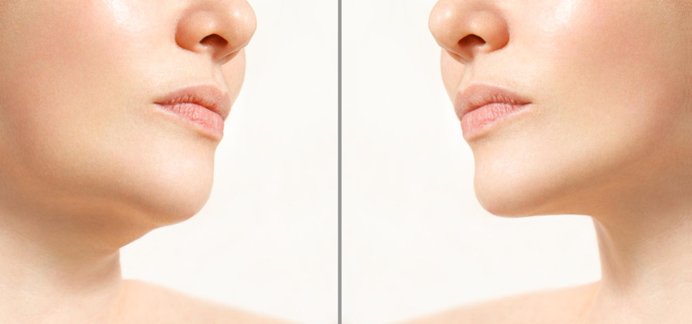 Chin Implant (CHIN AUGMENTATION)