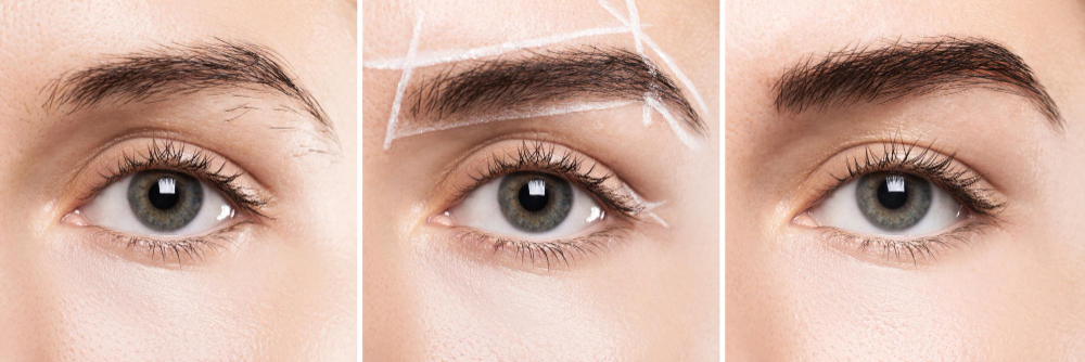 Eyebrow Transplant