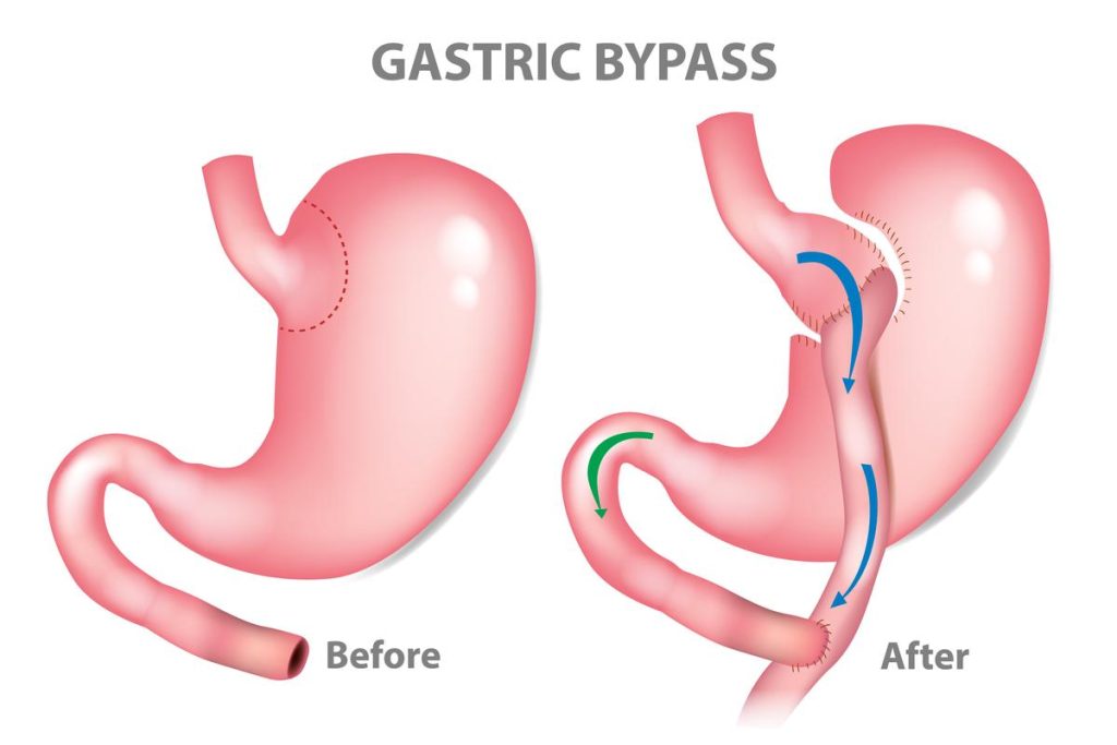 Gastric Bypass Surgery