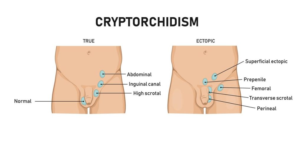 Undescended Testicles (Cryptorchidism)