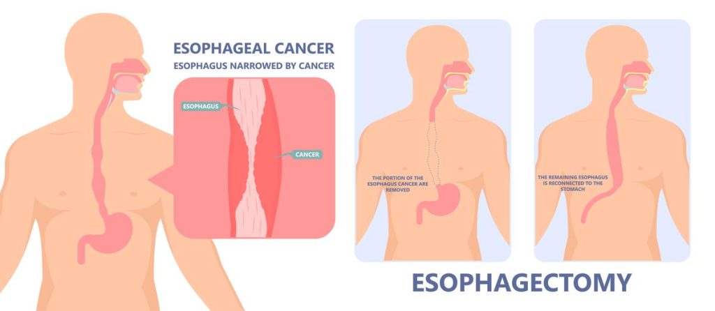 Esophagectomy