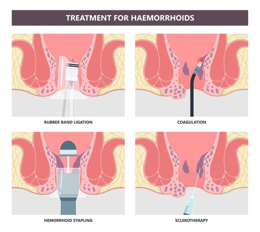 Hemorrhoid Surgery