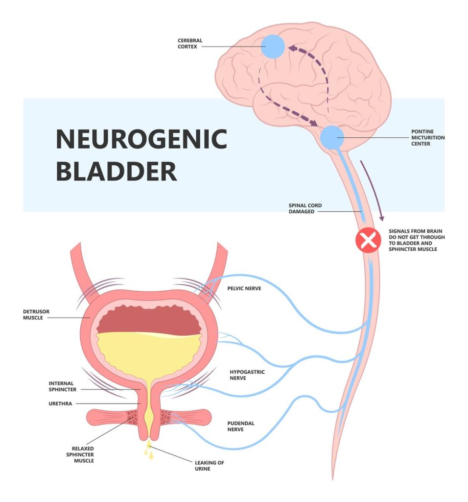 Neurogenic Bladder